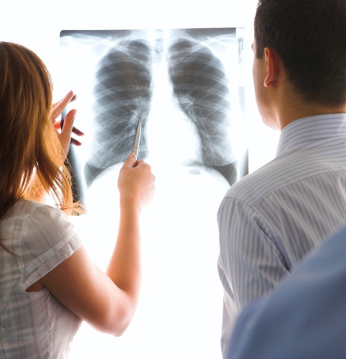 Doctors looking at a xray of longs. 